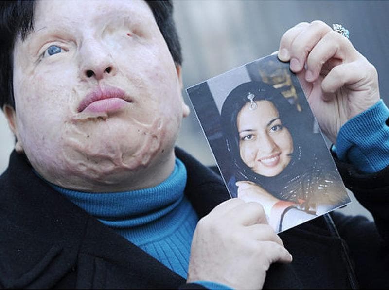 Ameneh Brahimi, korban penyiraman air keras yang dibolehkan pengadilan balas dendam ke pelaku. (Getty Images/Louis Gene)